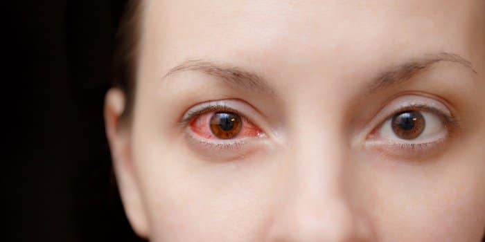 Conjonctivite - rougeurs oculaires